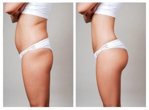 Illustration: Before and after Brazilian Butt Lift