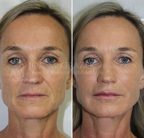 Before And After Face Lift | Newport Beach, CA | Dr. Grazer