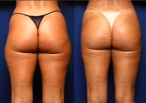 Grazer Liposuction Patient Before and After photo set