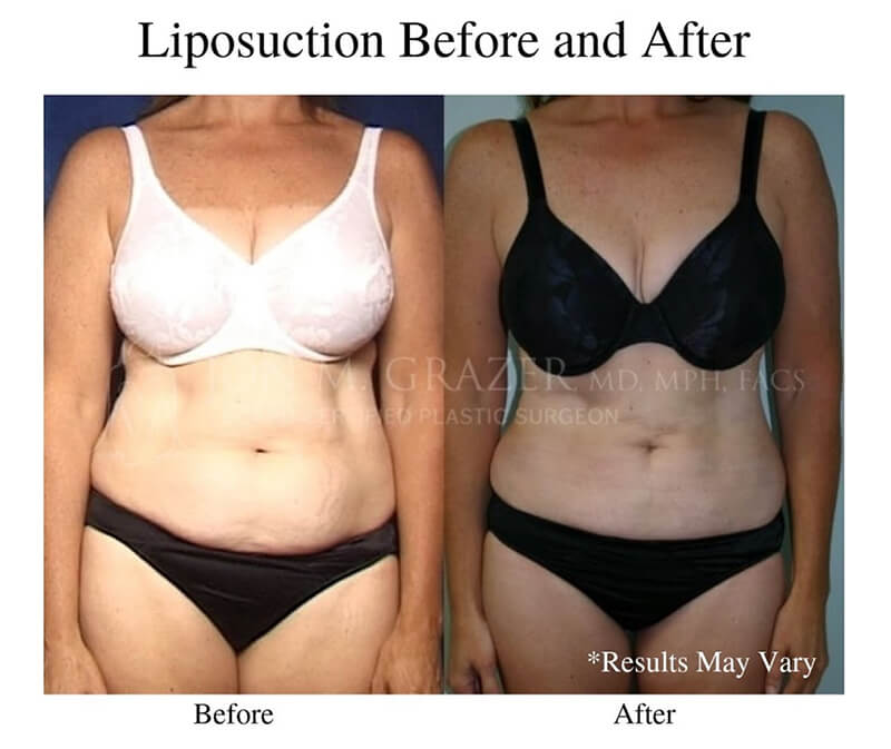 Before and after image of a woman after undergoing a liposuction procedure. Stubborn pockets of fat throughout the body are addressed by this method.