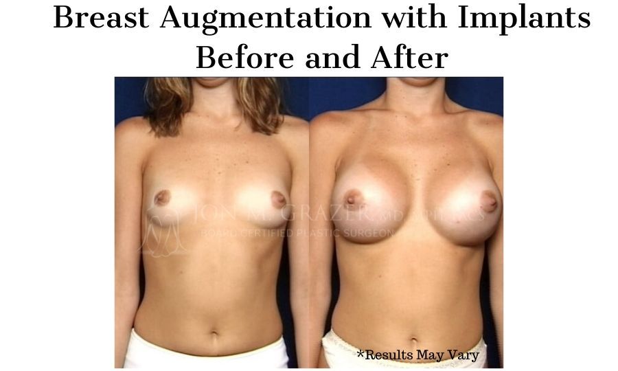 Before and after image showing the results of a breast augmentation with implants performed in Newport Beach, CA.