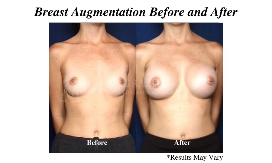 Before and after image showing the results of a breast augmentation performed in Newport Beach.