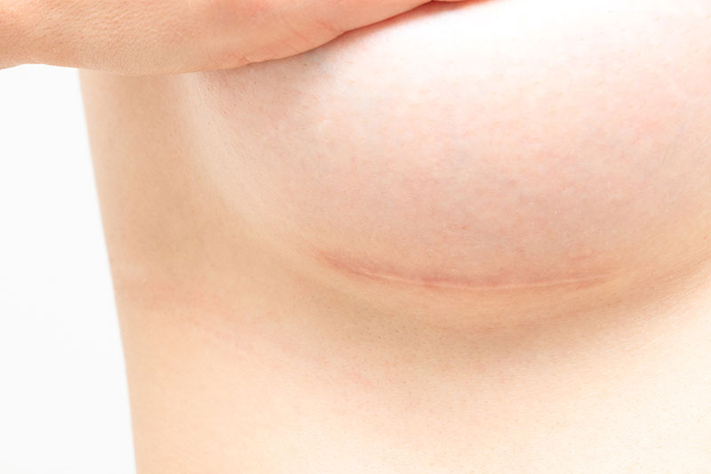 Close up of the barely visible scar under a woman's breast