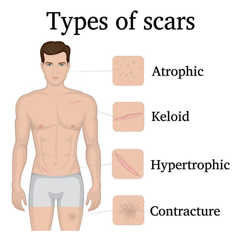 animated diagram illustrating types of scars