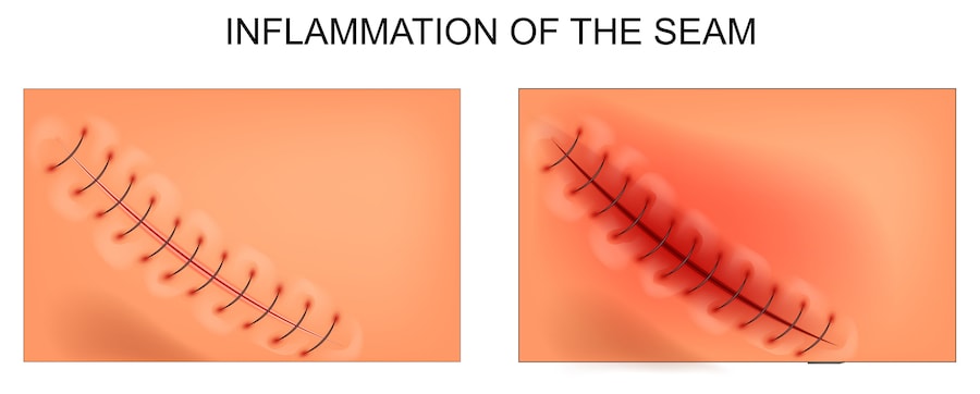 Illustration showing the difference between a healthy incision and inflamed incision.