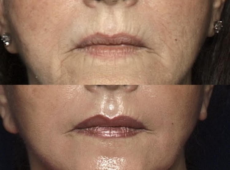 Laser Resurfacing Before and After