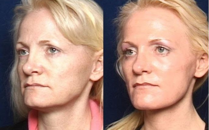 Face - Laser Resurfacing Before and After 