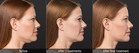 Kybella treatment: before, after 2 treatments, after final treatment