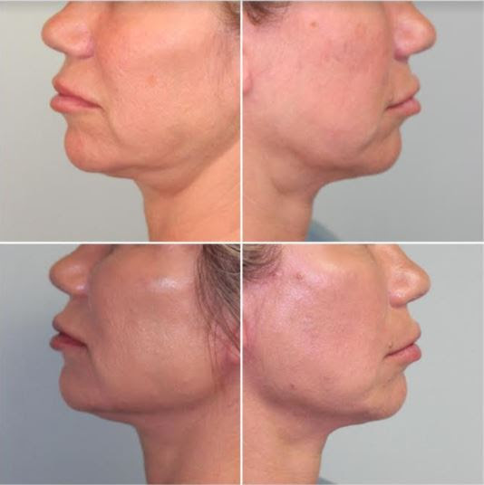 10% Off The G Lift - A Nonsurgical Face Lift
