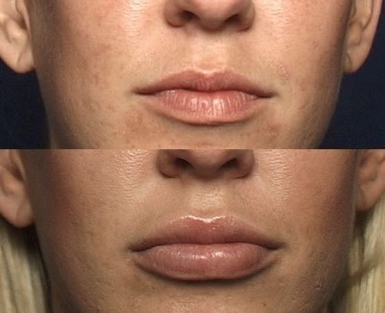 10% Off The PermaLip Implant Customized just for you!