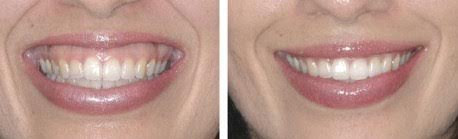  Relax a Gummy Smile with Botox!
