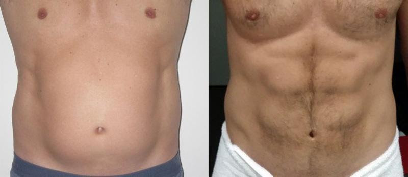 Get Ready for Summer!
High Definition Liposuction & Ab Etching