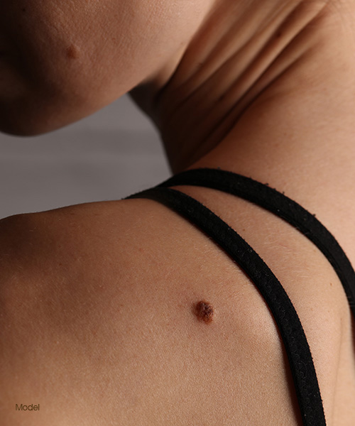 Woman with a mole on her shoulder