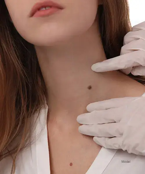 Woman having a mole inspected