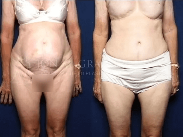 Before and After Image