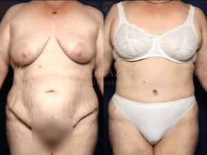 Before and After Image