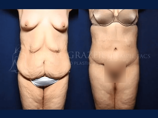 Before and After Image