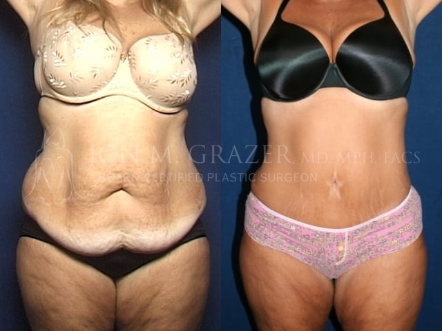 Abdominoplasty Patient Before and After | Newport Beach, CA | Dr. Grazer
