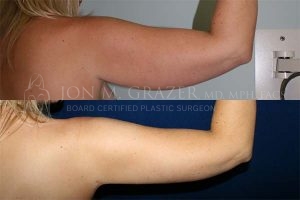 Before and After Image