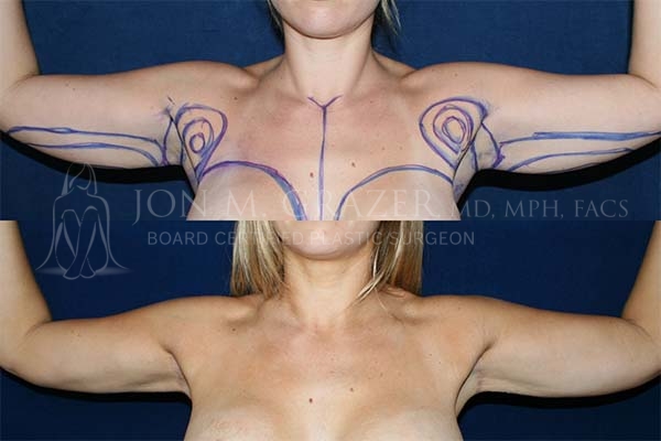 Before and After Image