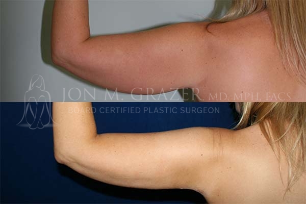 Before and After Image