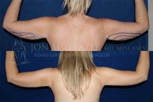 Before and After Image