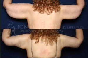 Before and After Image