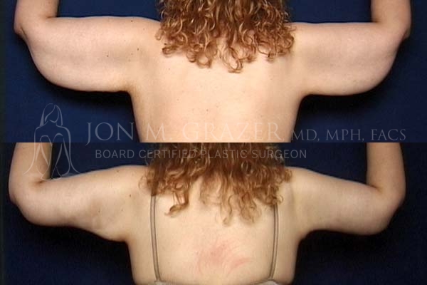 Before and After Image