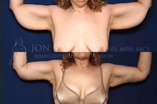 Before and After Image