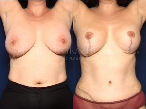 Before and After Image