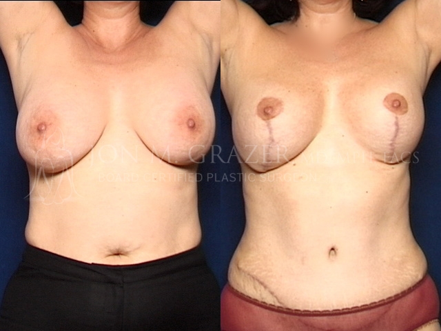 Before and After Image