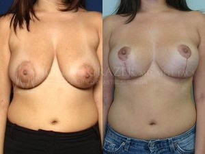 Before and After Image