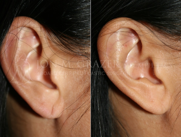 Before and After Image