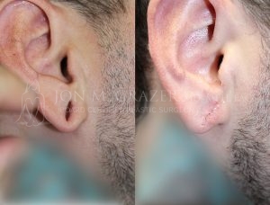 Before and After Image