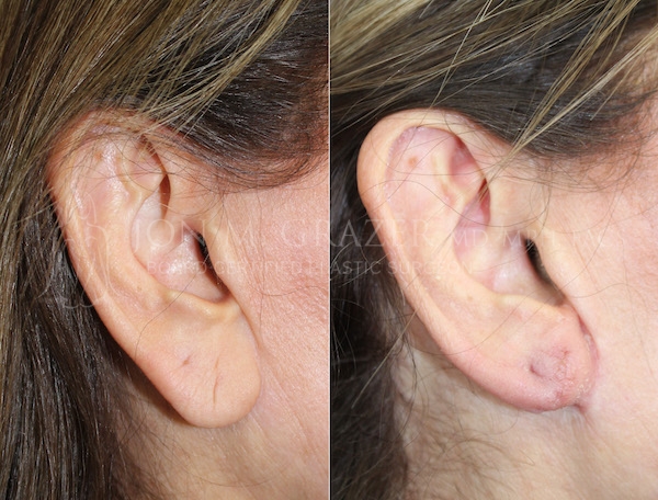 Before and After Image