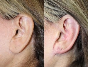 Before and After Image