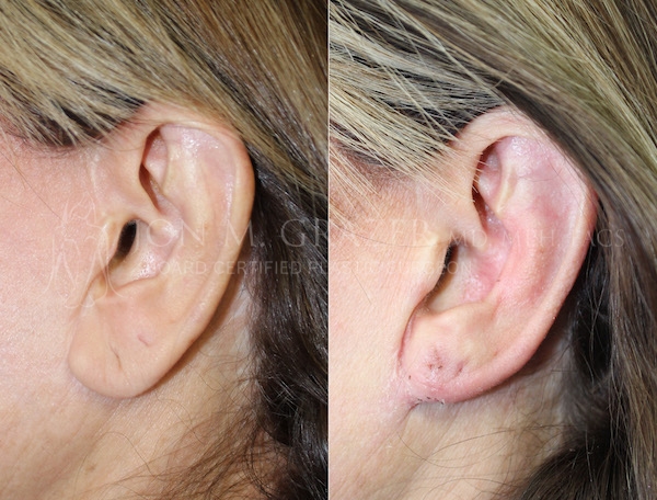 Before and After Image