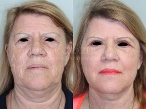 Before and After Image