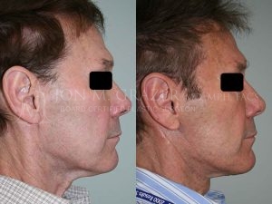 Before and After Image