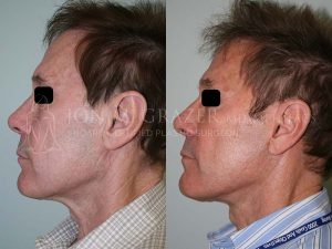 Before and After Image