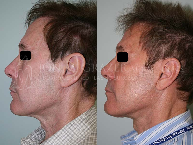 Before and After Image