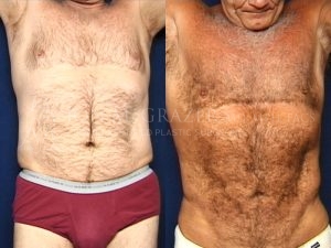 Before and After Image