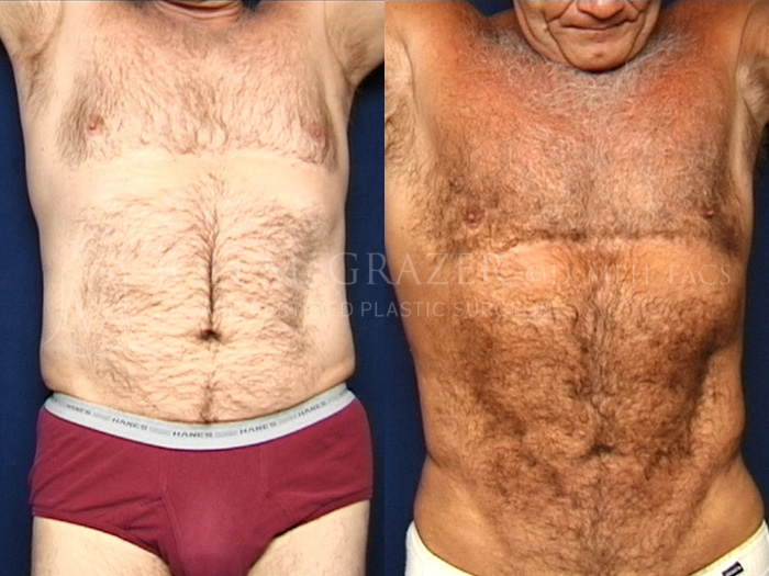 Before and After Image