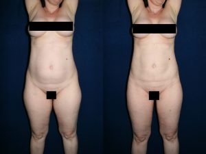 Before and After Image