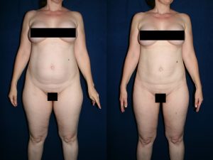 Before and After Image