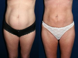 Before and After Image