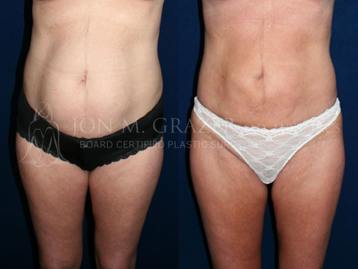 Before and After Image