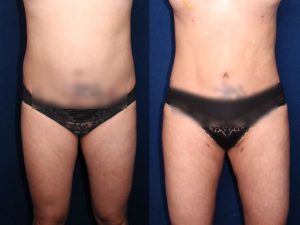 Before and After Image