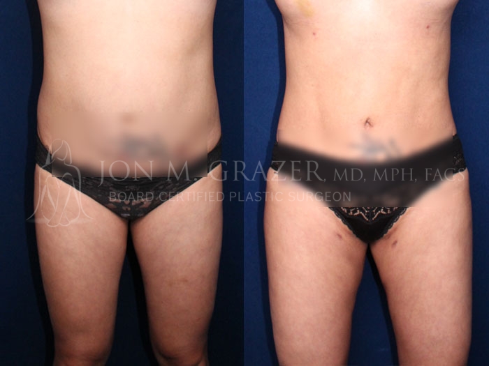 Before and After Image