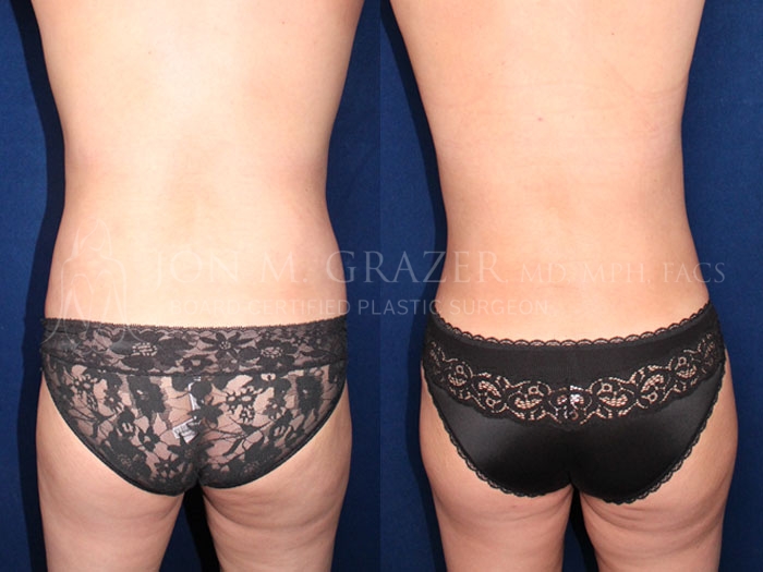 Before and After Image